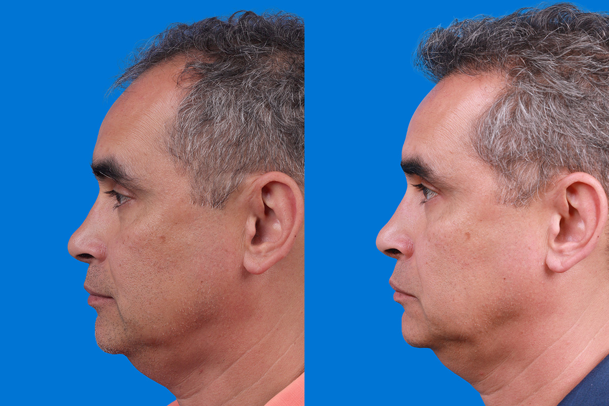 Hair Restoration Before & After Gallery - Patient 148467004 - Image 5