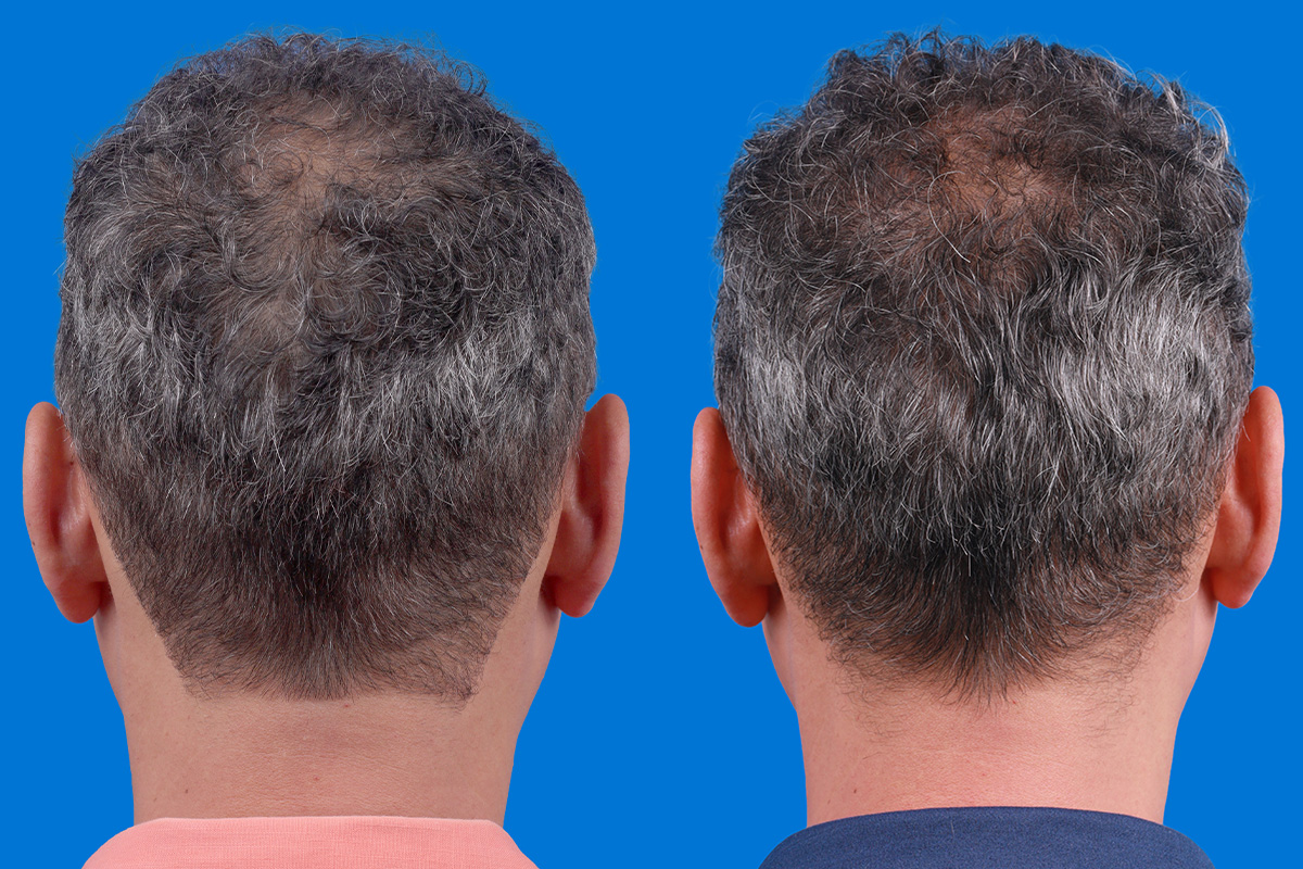 Hair Restoration Before & After Gallery - Patient 148467004 - Image 7