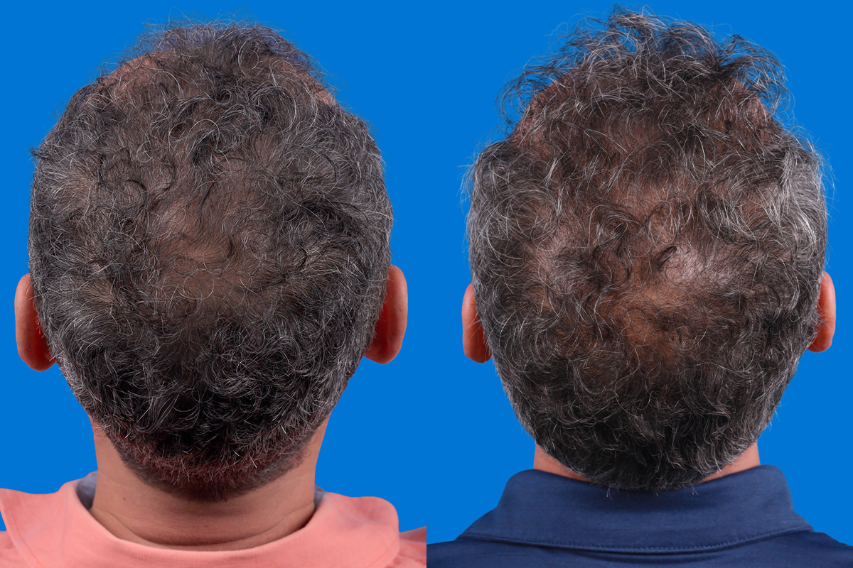 Hair Restoration Before & After Gallery - Patient 148467004 - Image 6