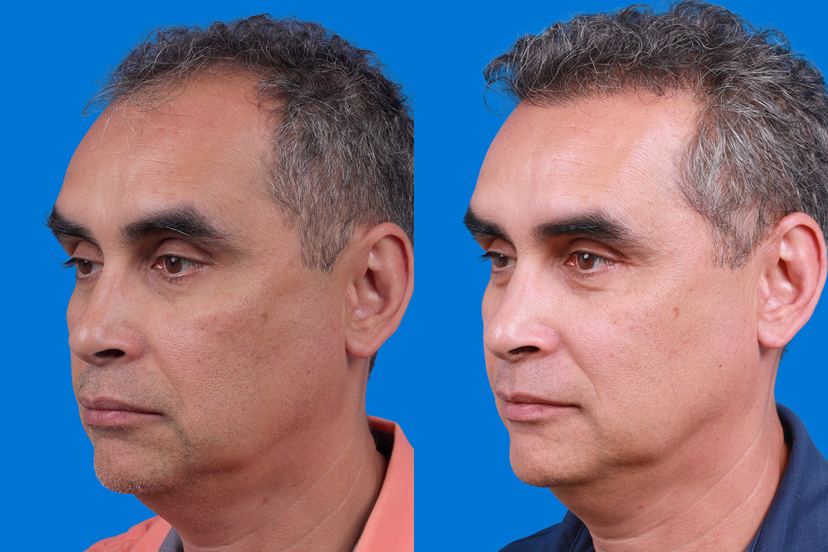 Hair Restoration Before & After Gallery - Patient 148467004 - Image 4