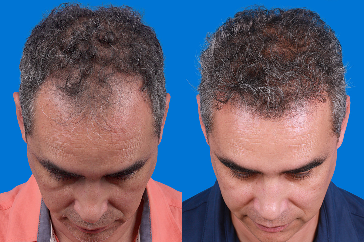 Hair Restoration Before & After Gallery - Patient 148467004 - Image 8