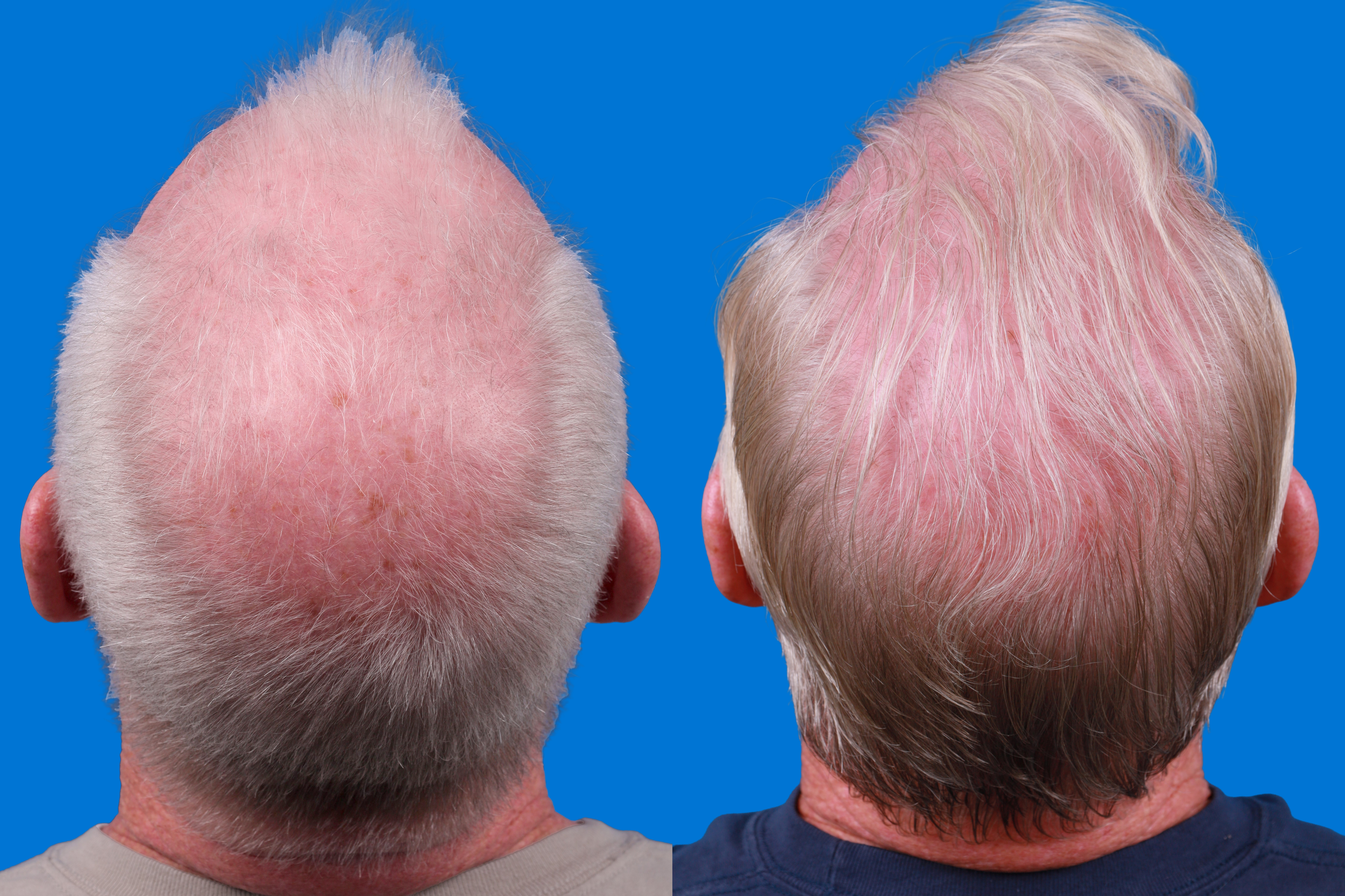 Hair Restoration Before & After Gallery - Patient 286463 - Image 3