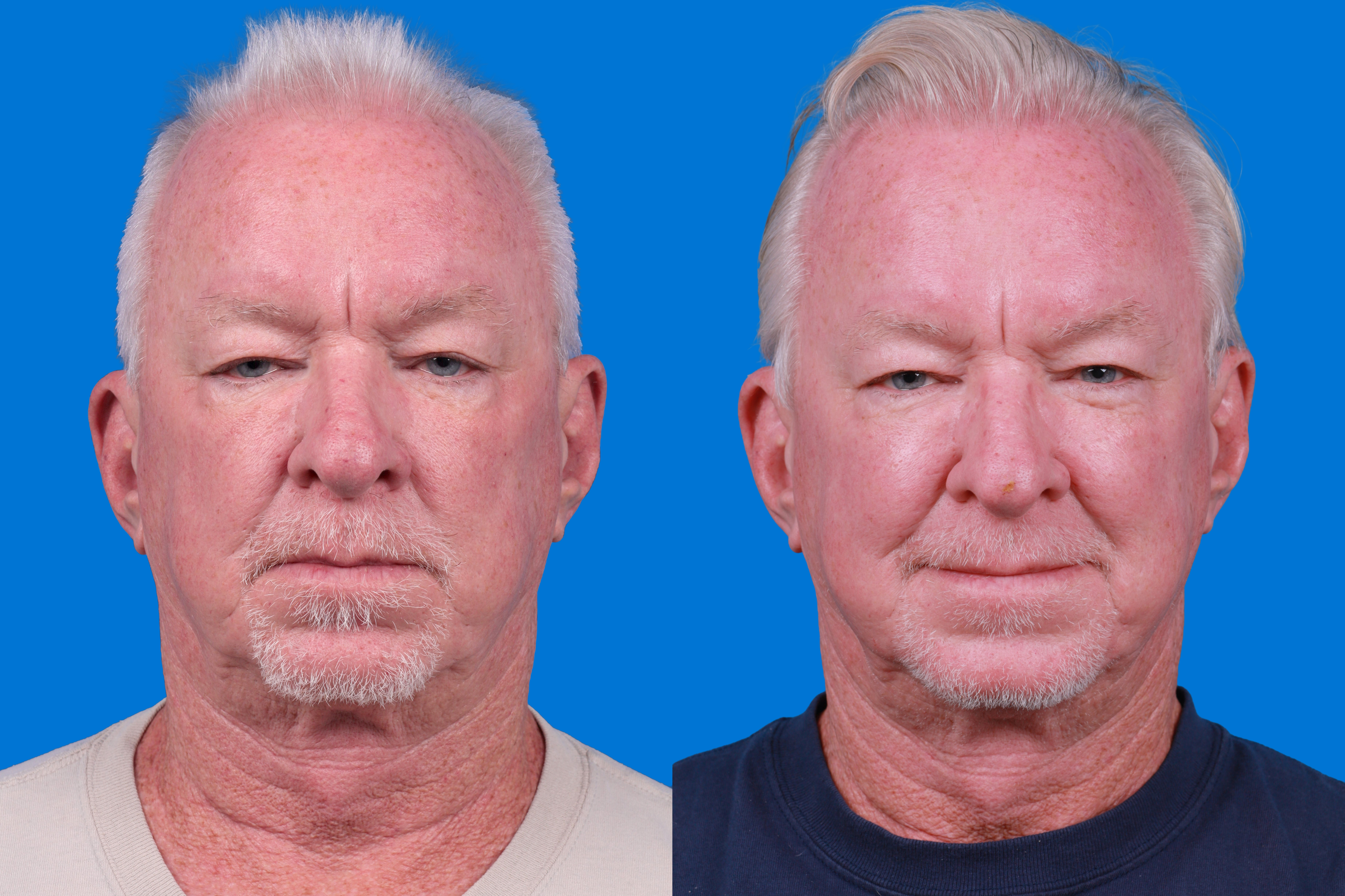 Hair Restoration Before & After Gallery - Patient 286463 - Image 1