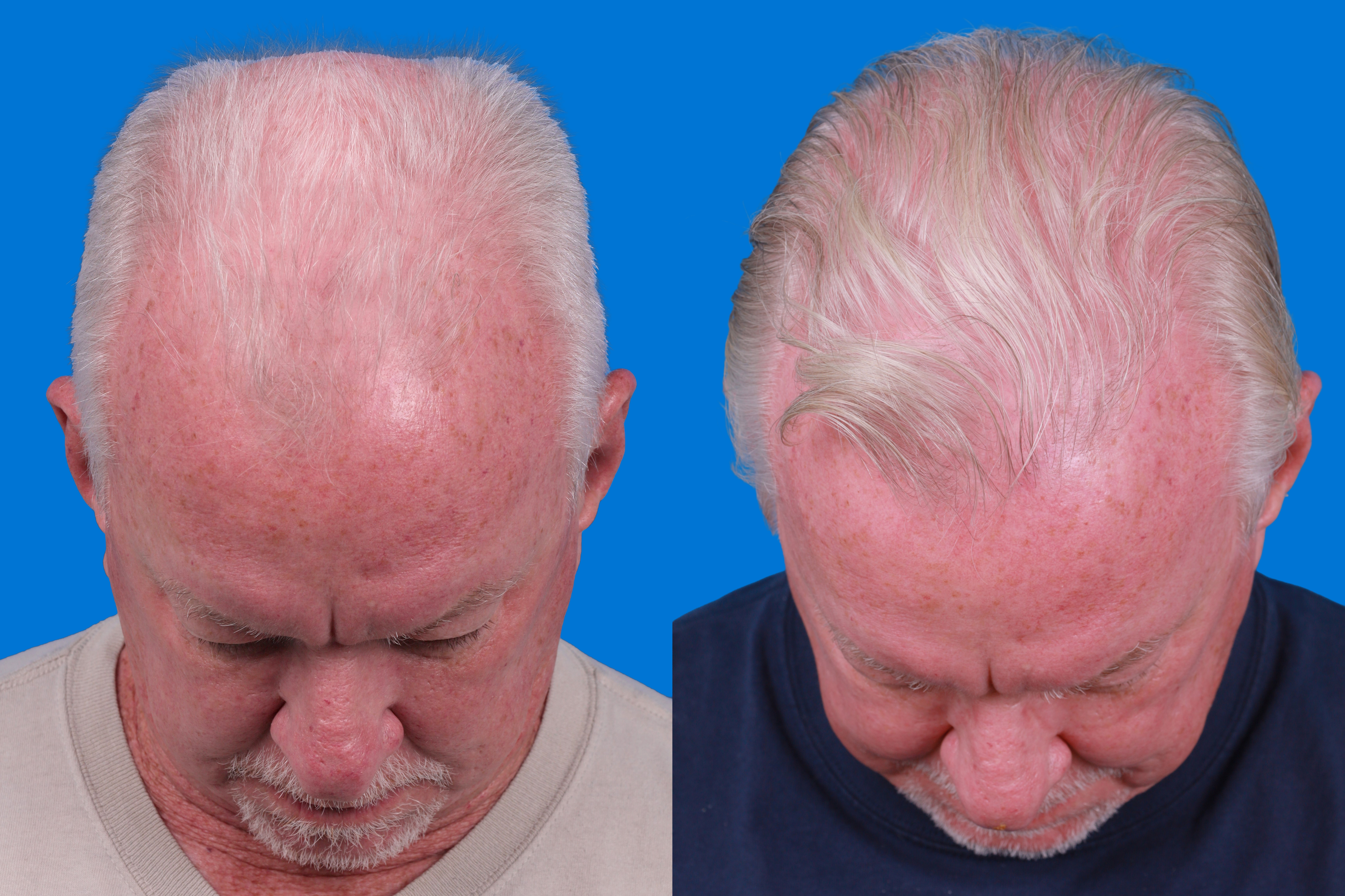 Hair Restoration Before & After Gallery - Patient 286463 - Image 2