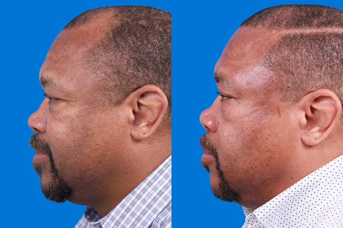 Hair Restoration Before & After Gallery - Patient 232040 - Image 5