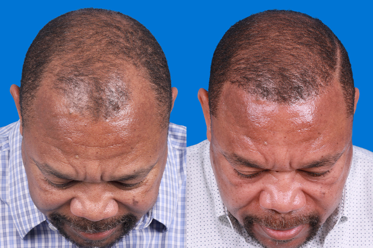 Hair Restoration Before & After Gallery - Patient 232040 - Image 8