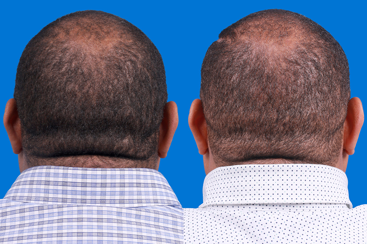 Hair Restoration Before & After Gallery - Patient 232040 - Image 6