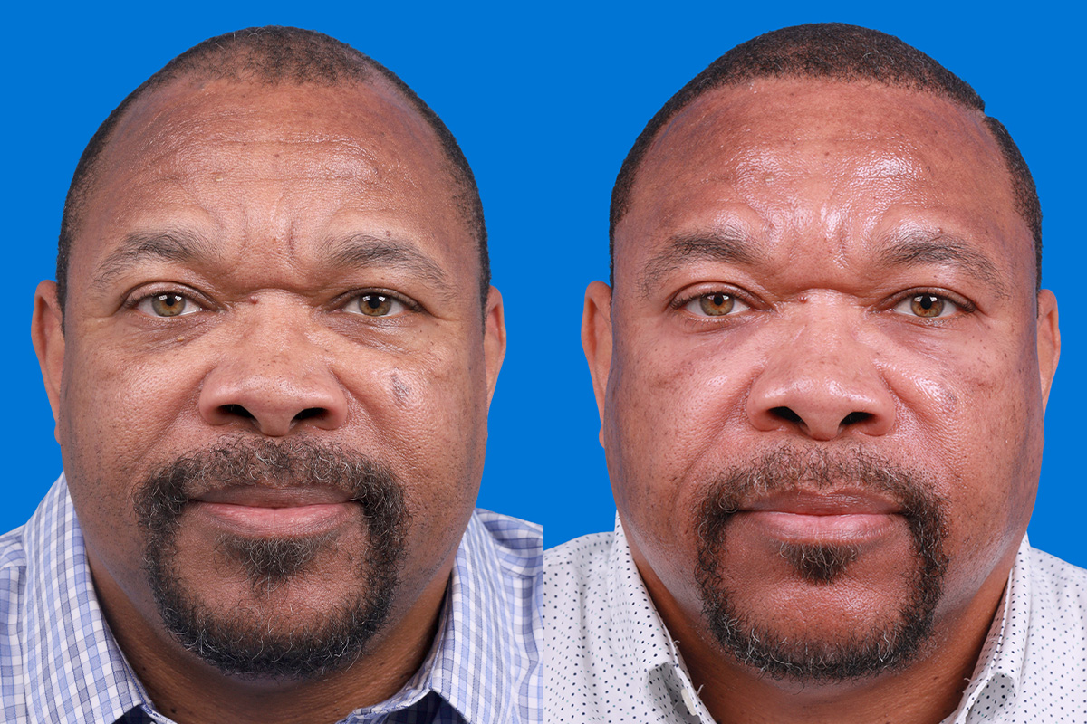 Hair Restoration Before & After Gallery - Patient 232040 - Image 1