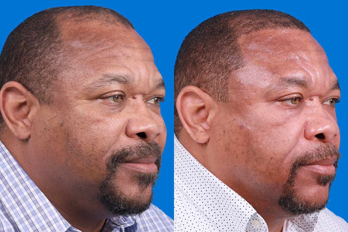 Hair Restoration Before & After Gallery - Patient 232040 - Image 2