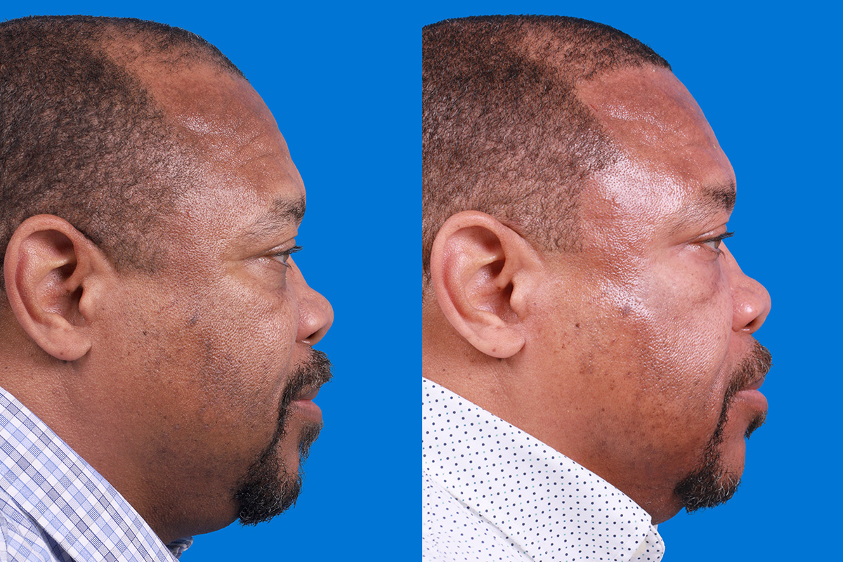 Hair Restoration Before & After Gallery - Patient 232040 - Image 3