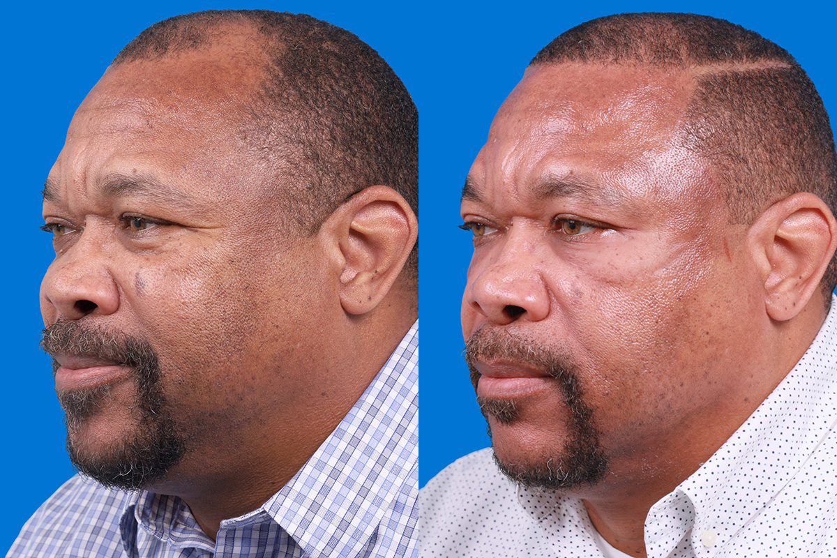 Hair Restoration Before & After Gallery - Patient 232040 - Image 4