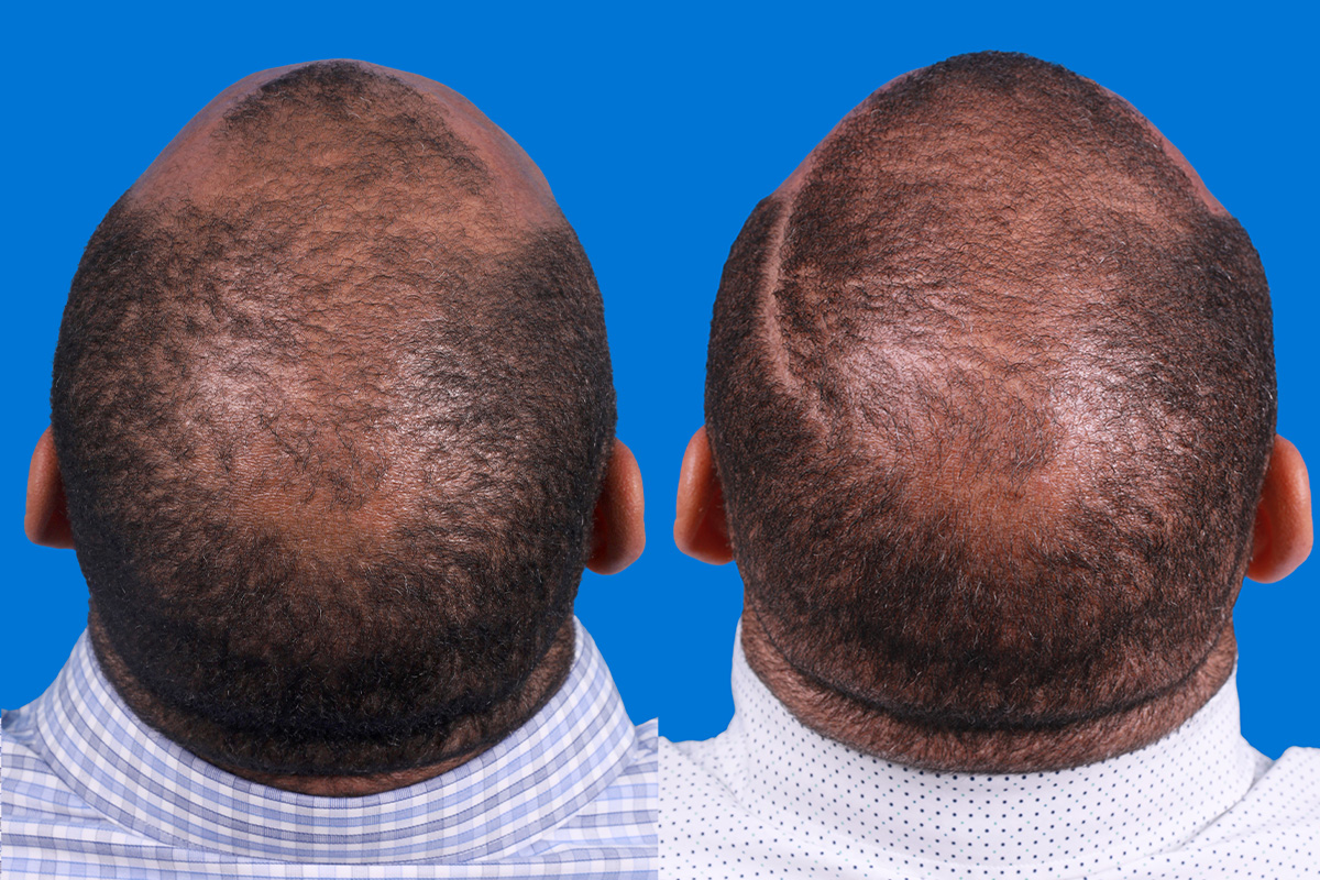 Hair Restoration Before & After Gallery - Patient 232040 - Image 7