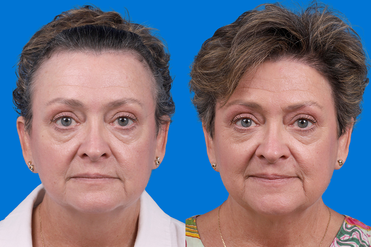 Hair Restoration Before & After Gallery - Patient 241763 - Image 1