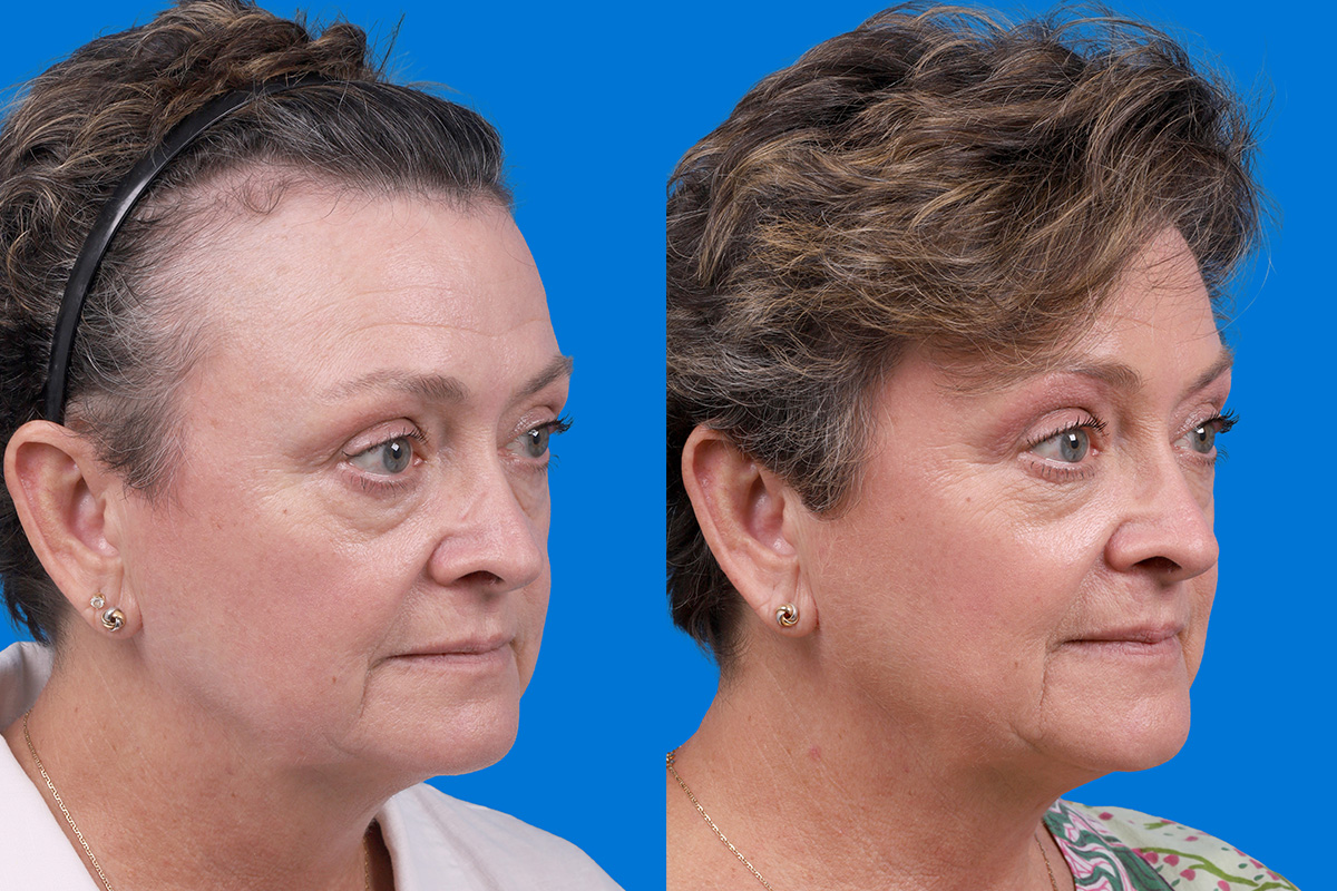 Hair Restoration Before & After Gallery - Patient 241763 - Image 2