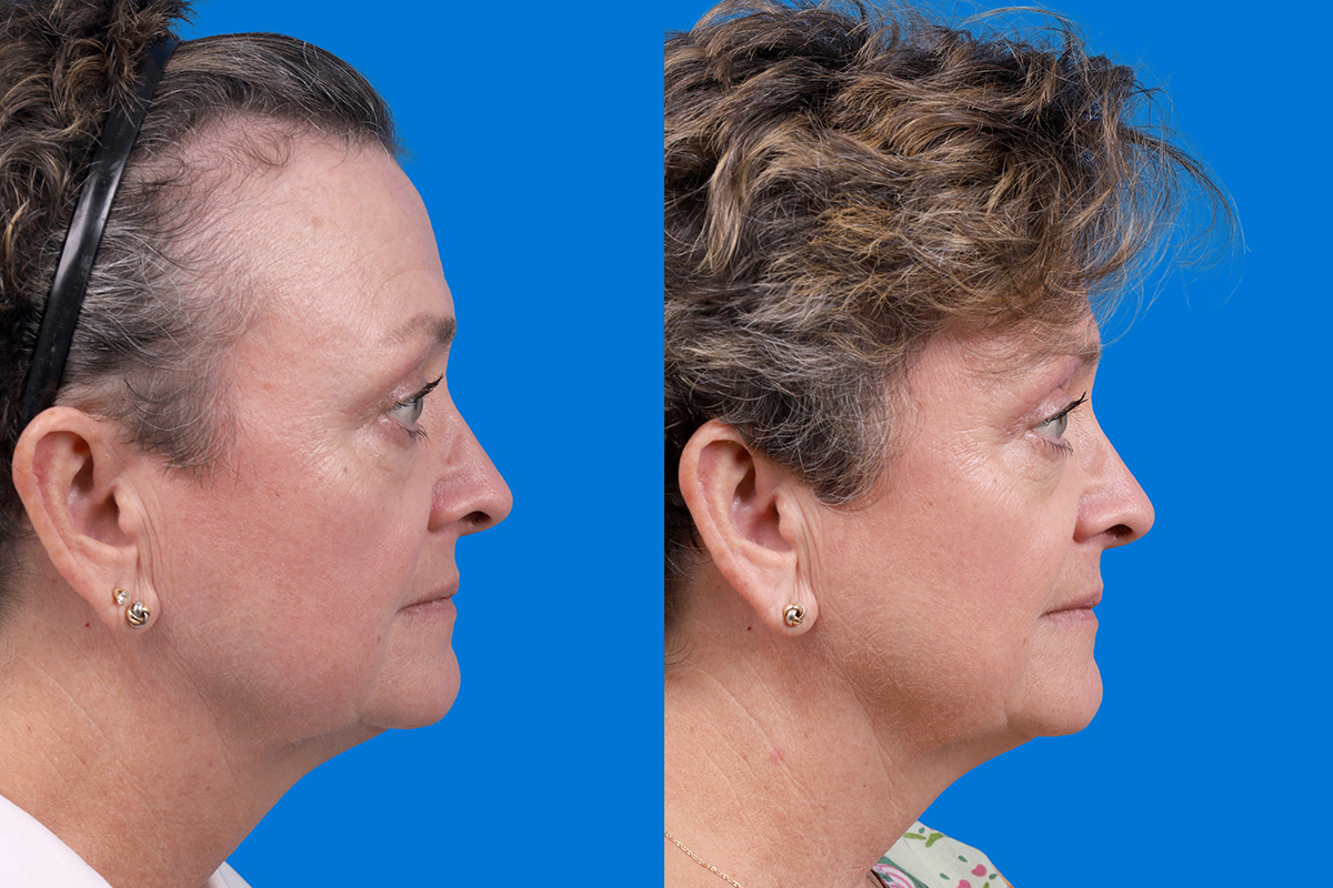 Hair Restoration Before & After Gallery - Patient 241763 - Image 3