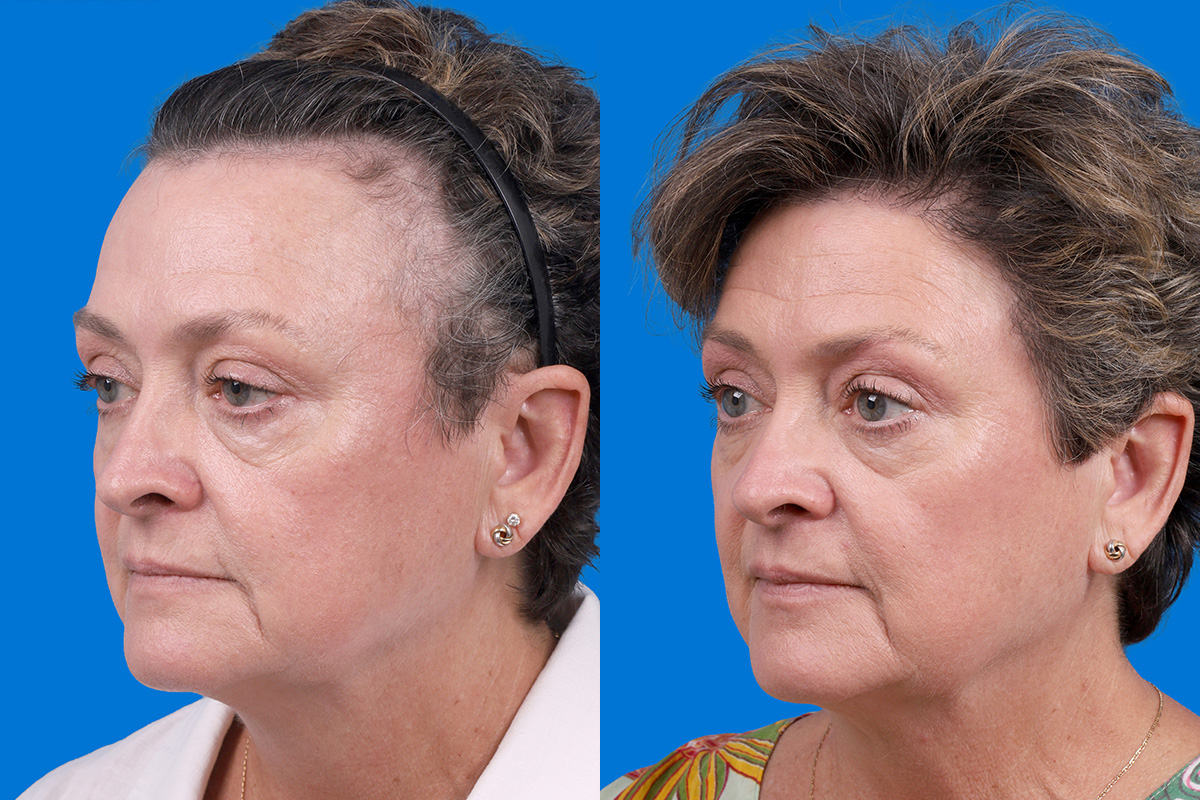Hair Restoration Before & After Gallery - Patient 241763 - Image 4