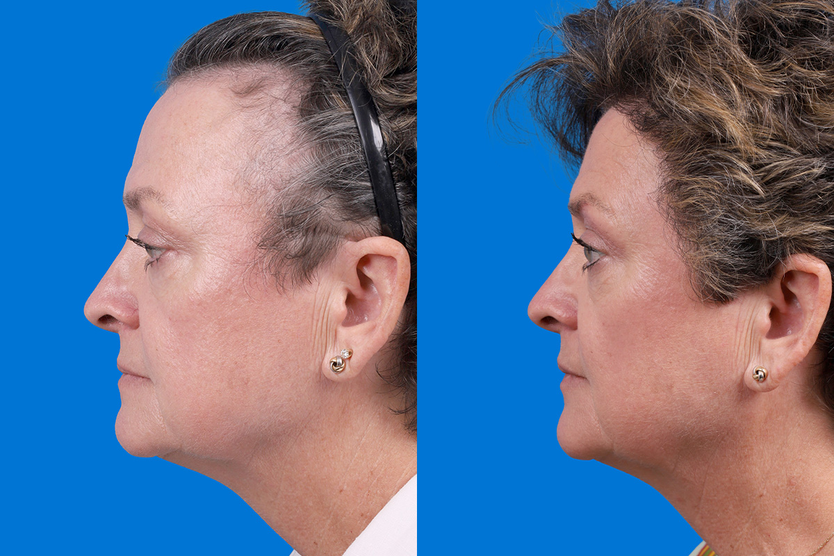 Hair Restoration Before & After Gallery - Patient 241763 - Image 5