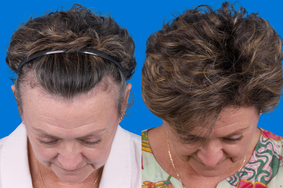Hair Restoration Before & After Gallery - Patient 241763 - Image 8