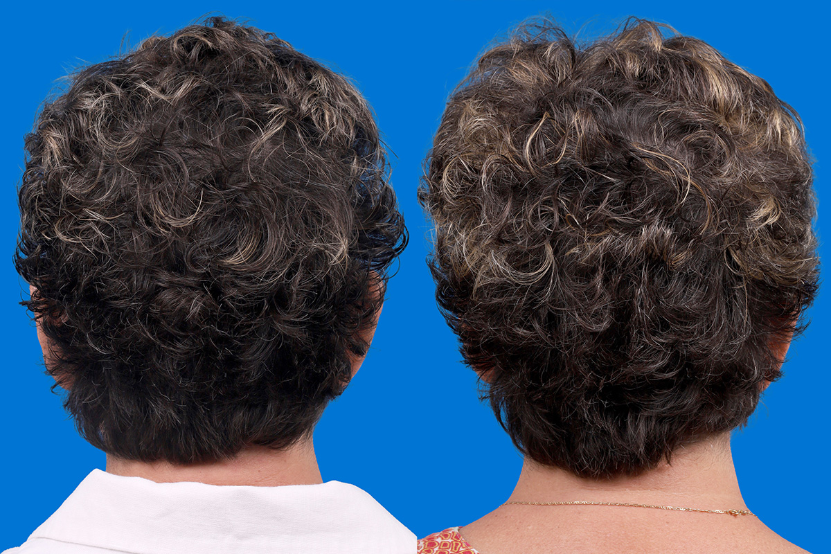 Hair Restoration Before & After Gallery - Patient 241763 - Image 7