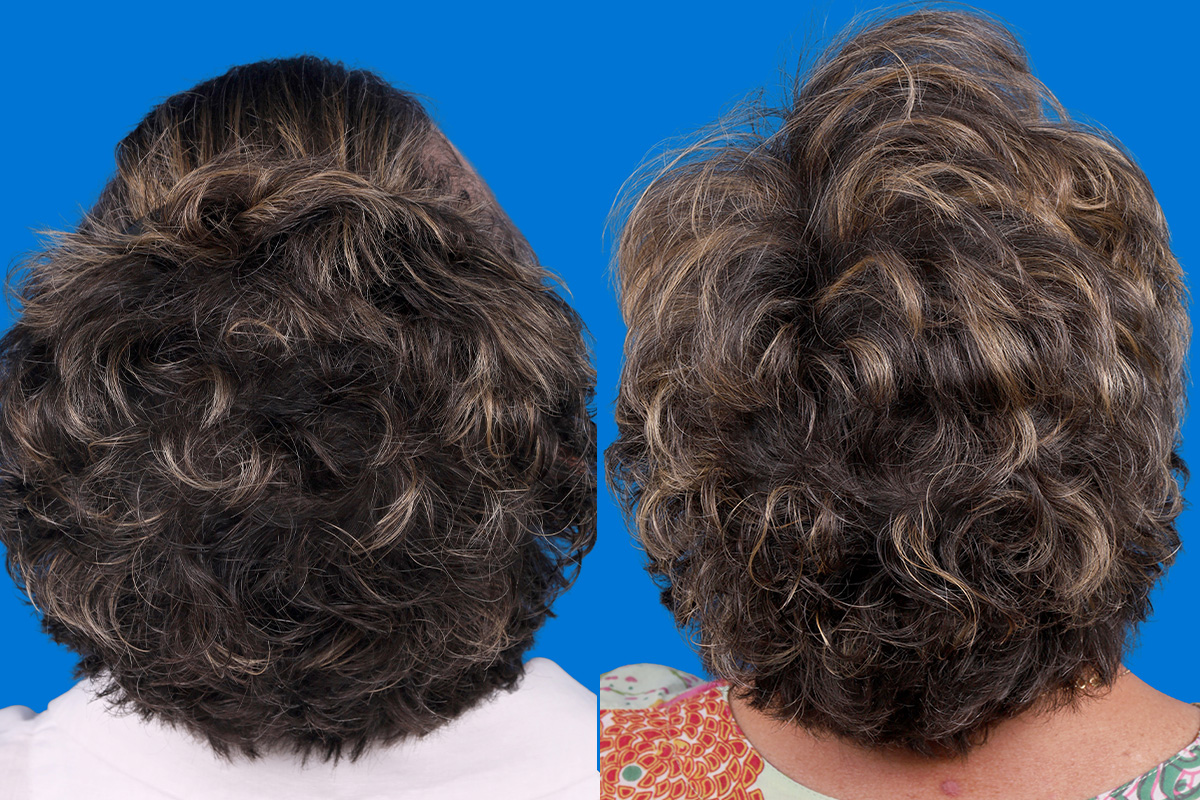 Hair Restoration Before & After Gallery - Patient 241763 - Image 6