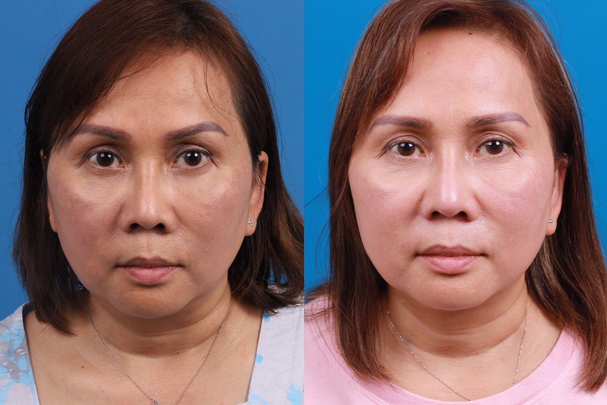 Rhinoplasty Before & After Gallery - Patient 227546 - Image 1