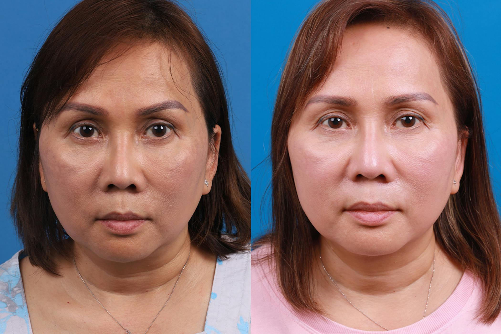 Rhinoplasty Procedure