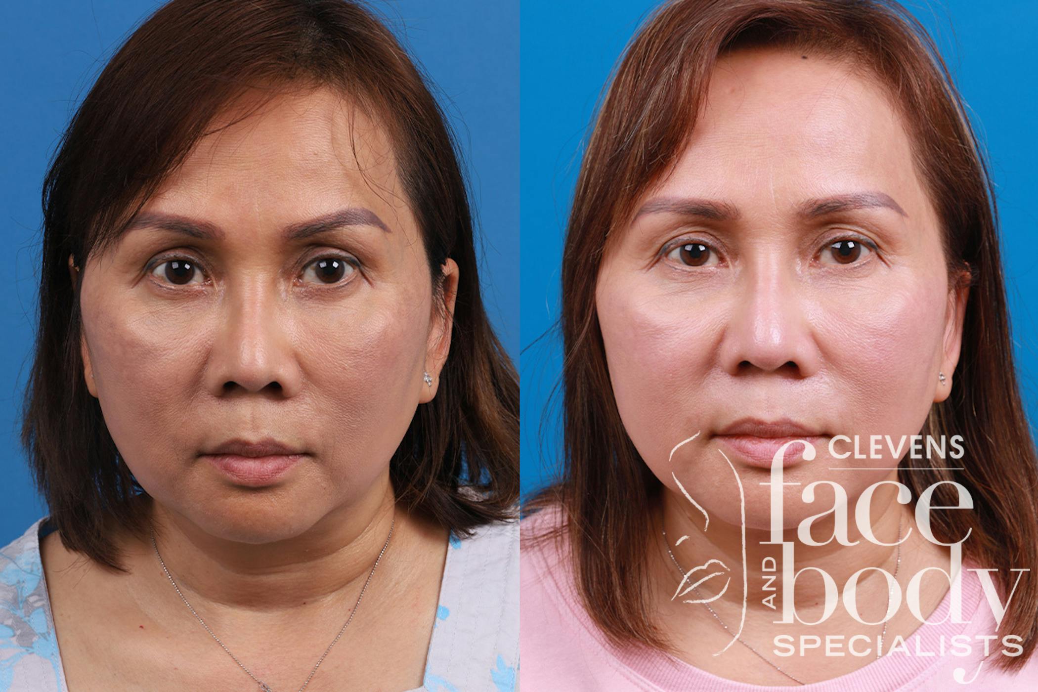 Rhinoplasty Procedure