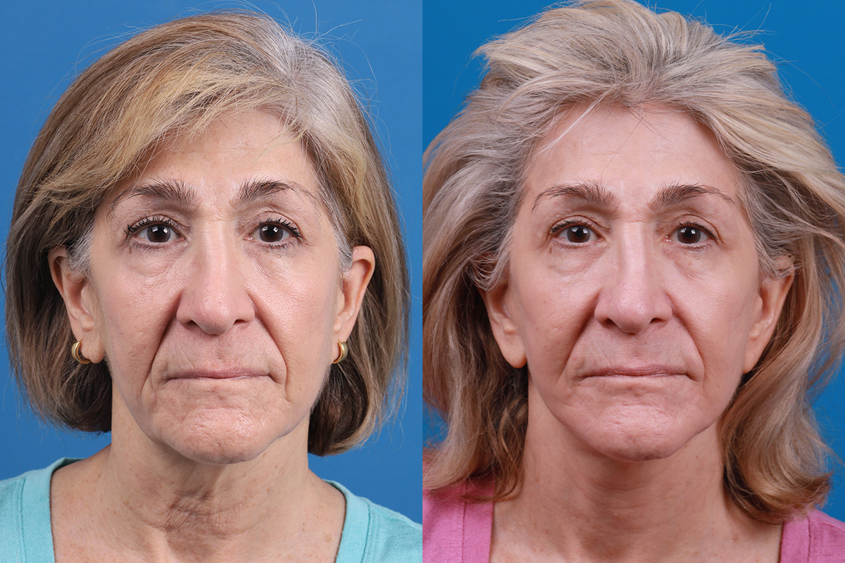 Facelift Before & After Gallery - Patient 183877 - Image 1