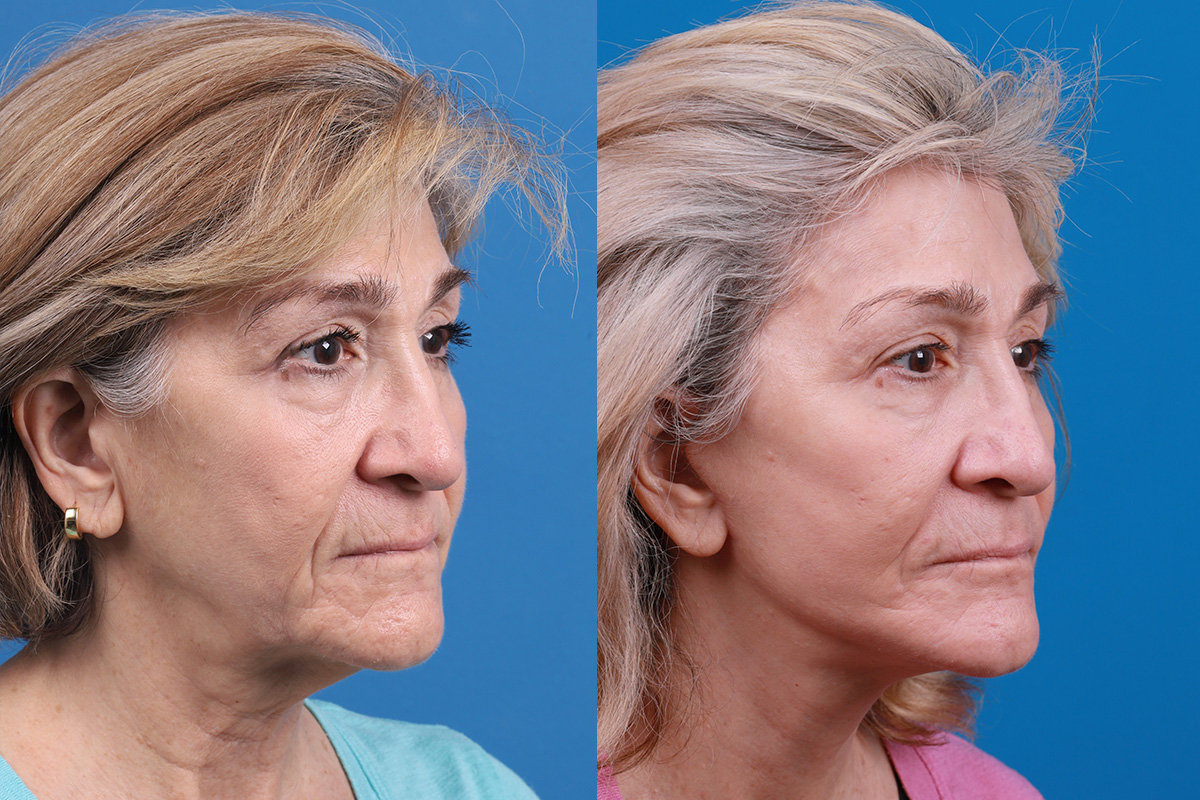 Facelift Before & After Gallery - Patient 183877 - Image 2