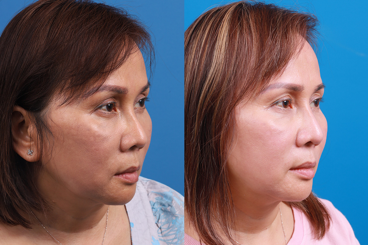 Rhinoplasty Before & After Gallery - Patient 227546 - Image 2