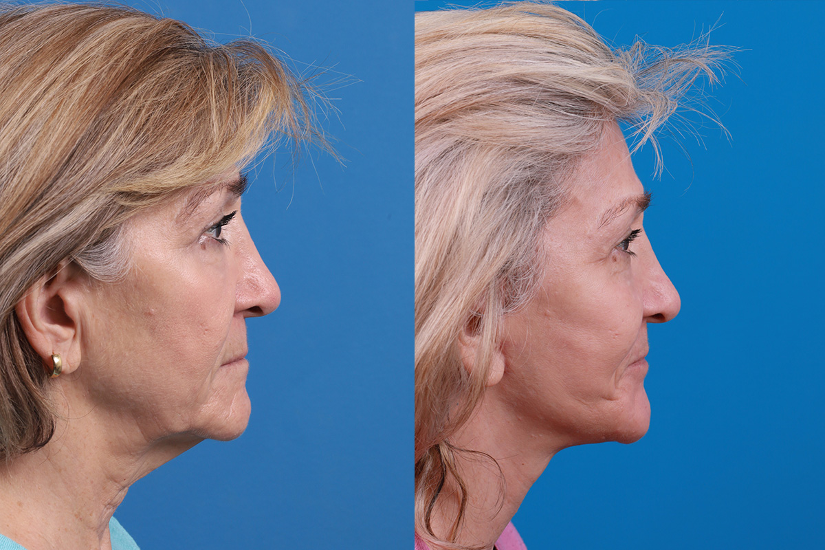 Facelift Before & After Gallery - Patient 183877 - Image 3