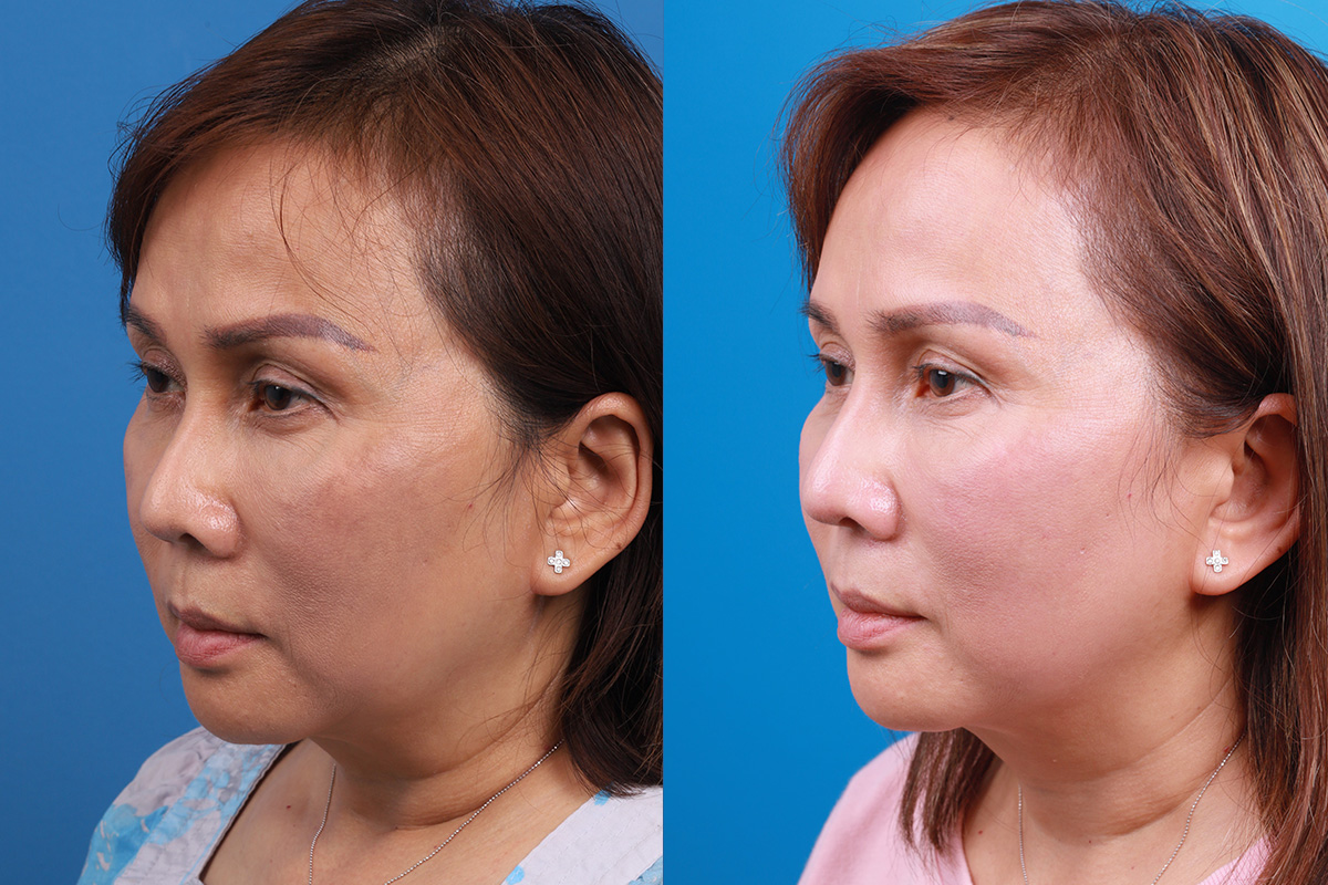Rhinoplasty Before & After Gallery - Patient 227546 - Image 4