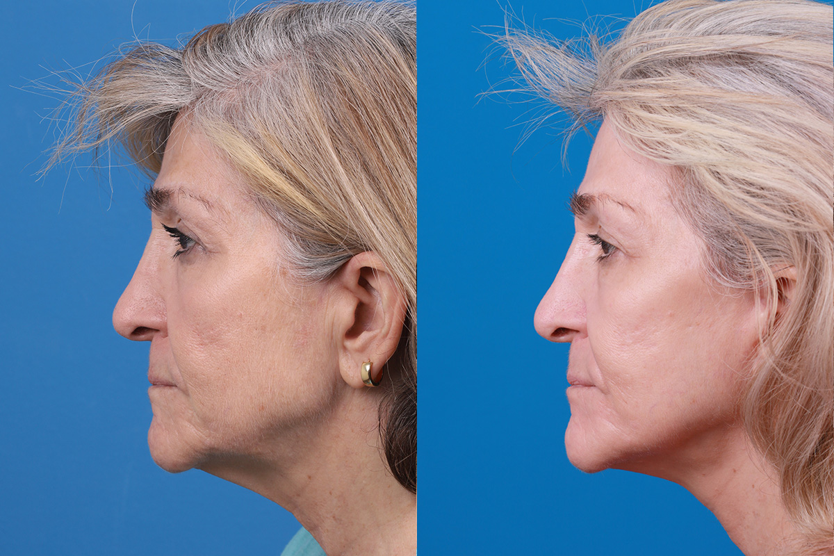 Facelift Before & After Gallery - Patient 183877 - Image 5