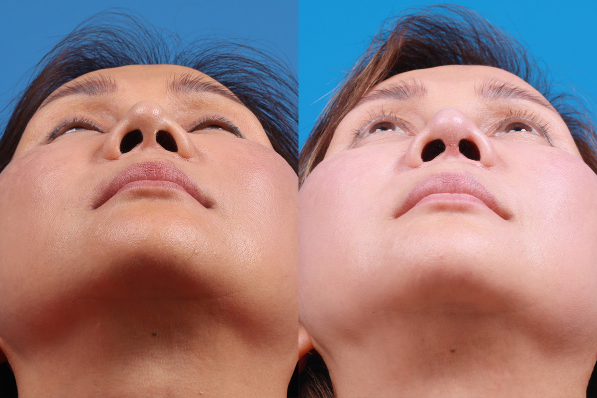Rhinoplasty Before & After Gallery - Patient 227546 - Image 6