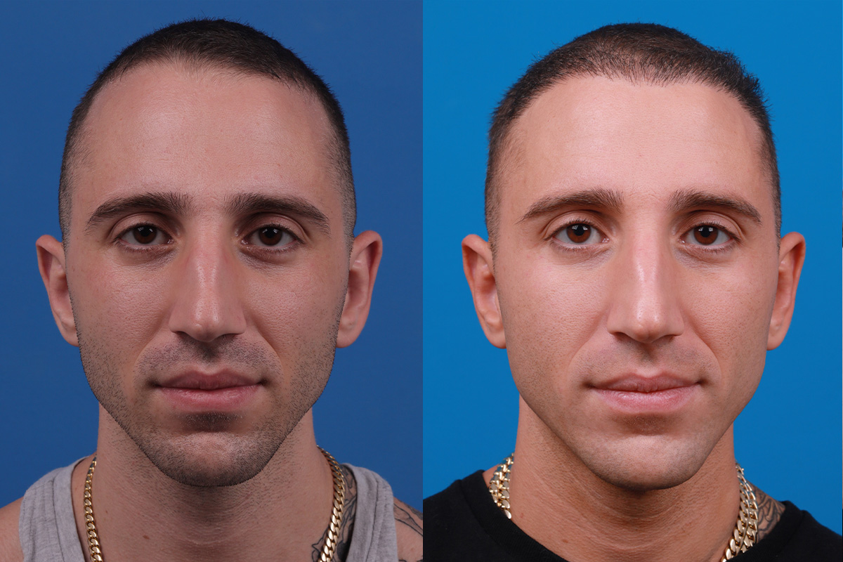 Hair Restoration Before & After Gallery - Patient 104786 - Image 1