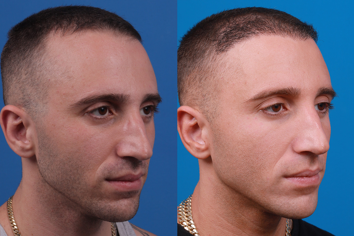 Hair Restoration Before & After Gallery - Patient 104786 - Image 2