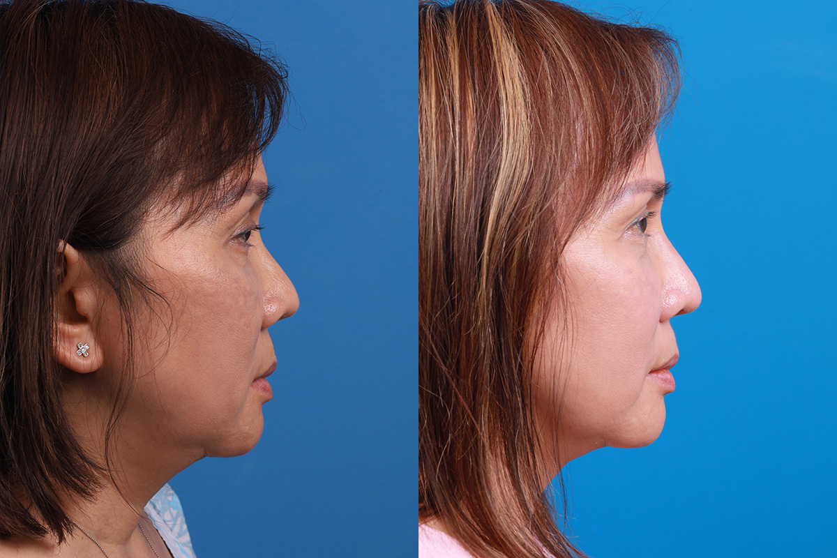 Rhinoplasty Before & After Gallery - Patient 227546 - Image 3
