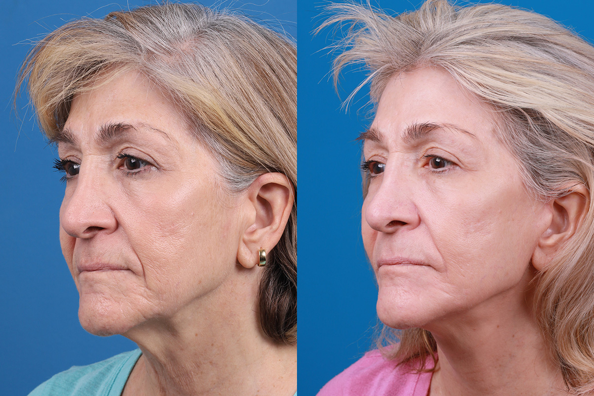 Facelift Before & After Gallery - Patient 183877 - Image 4