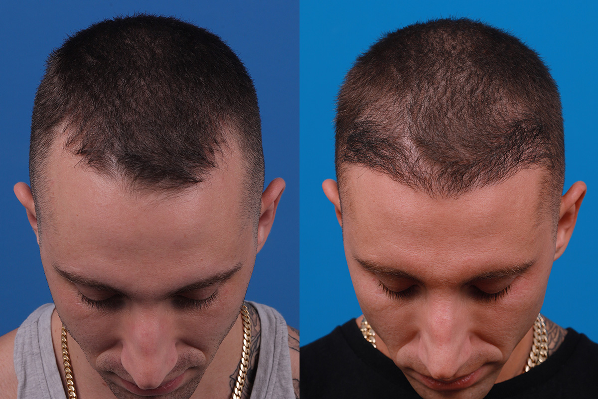 Hair Restoration Before & After Gallery - Patient 104786 - Image 6