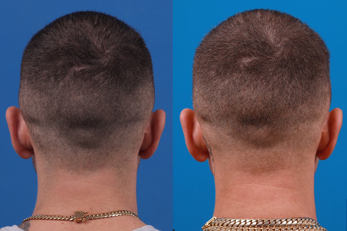 Hair Restoration Before & After Gallery - Patient 104786 - Image 8