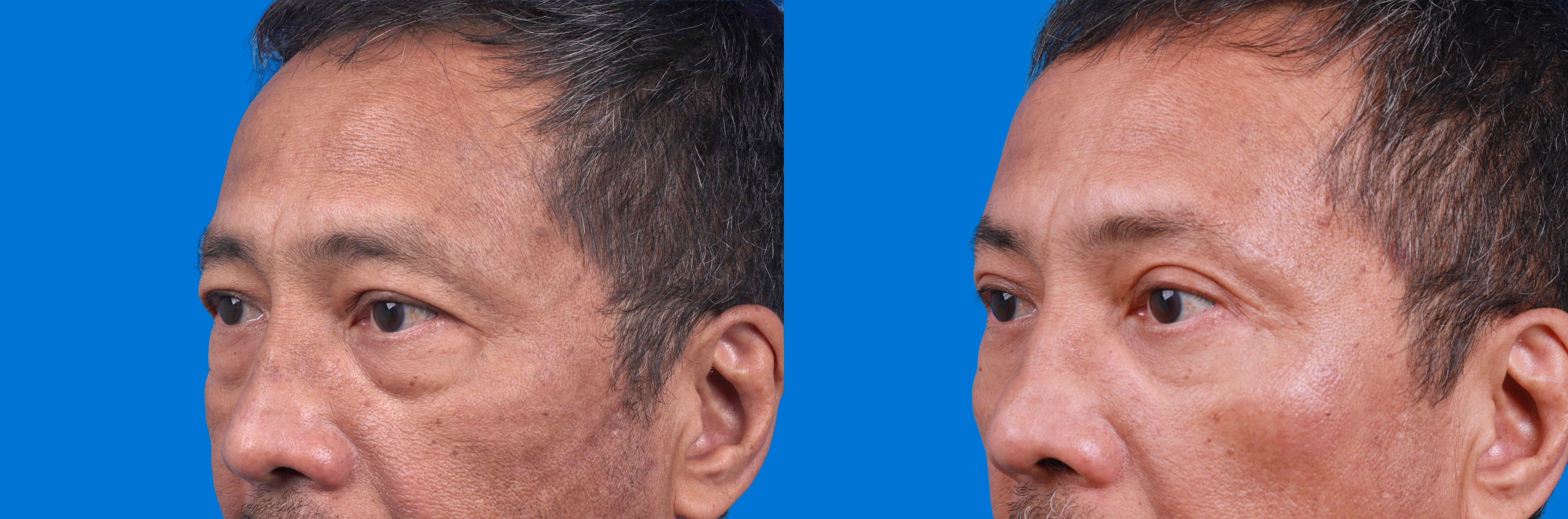 Brow Lift Before & After Gallery - Patient 184320278 - Image 3