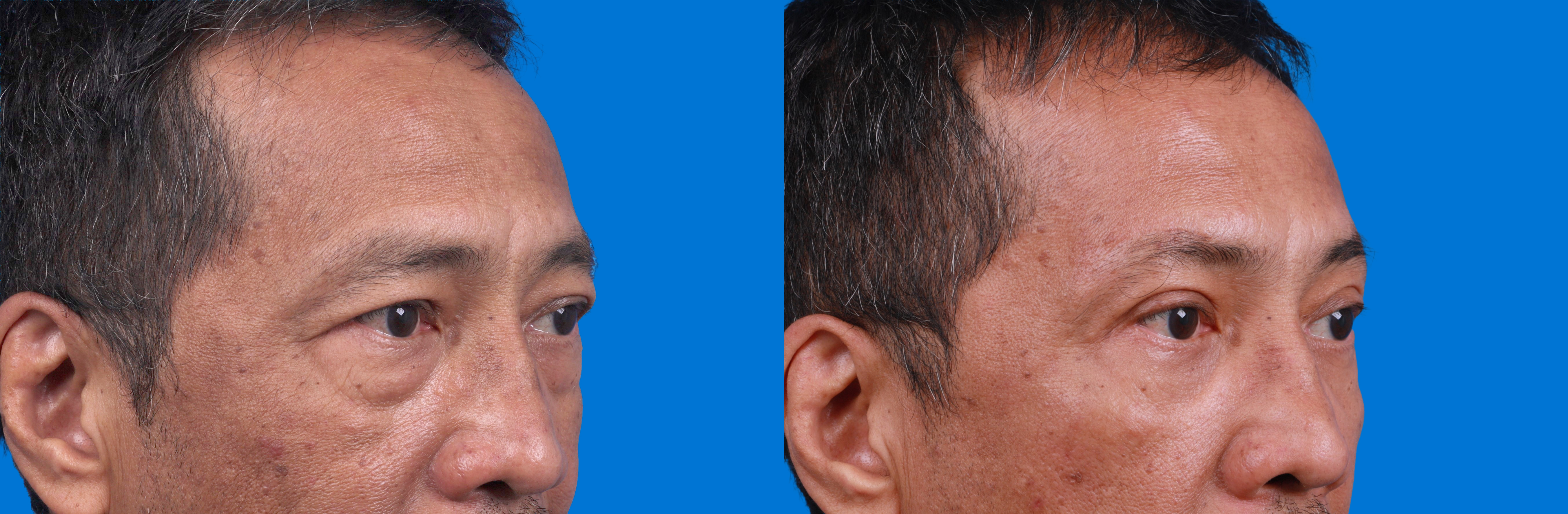 Brow Lift Before & After Gallery - Patient 184320278 - Image 2