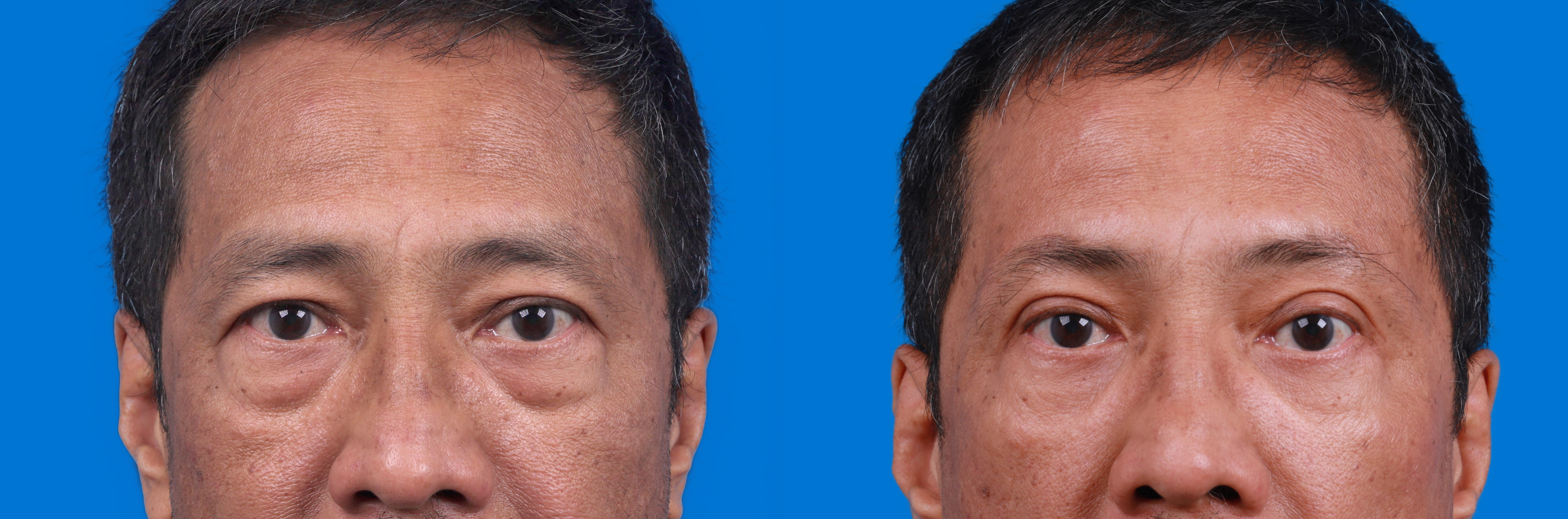 Brow Lift Before & After Gallery - Patient 184320278 - Image 1