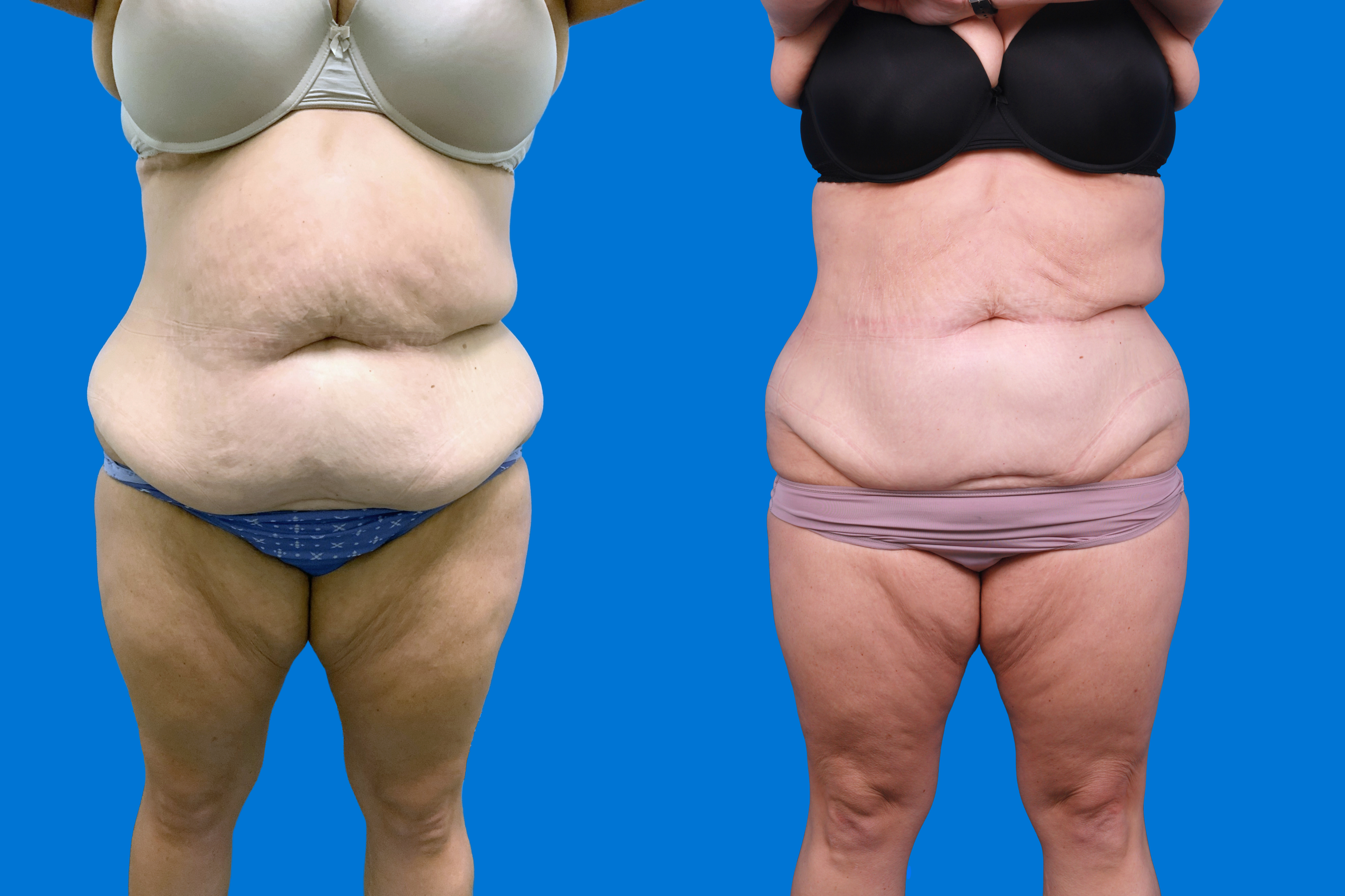 CoolSculpting Before & After Gallery - Patient 428361 - Image 1
