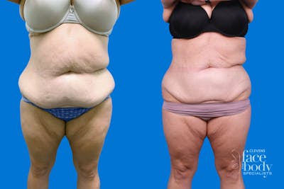 CoolSculpting Before & After Gallery - Patient 428361 - Image 1