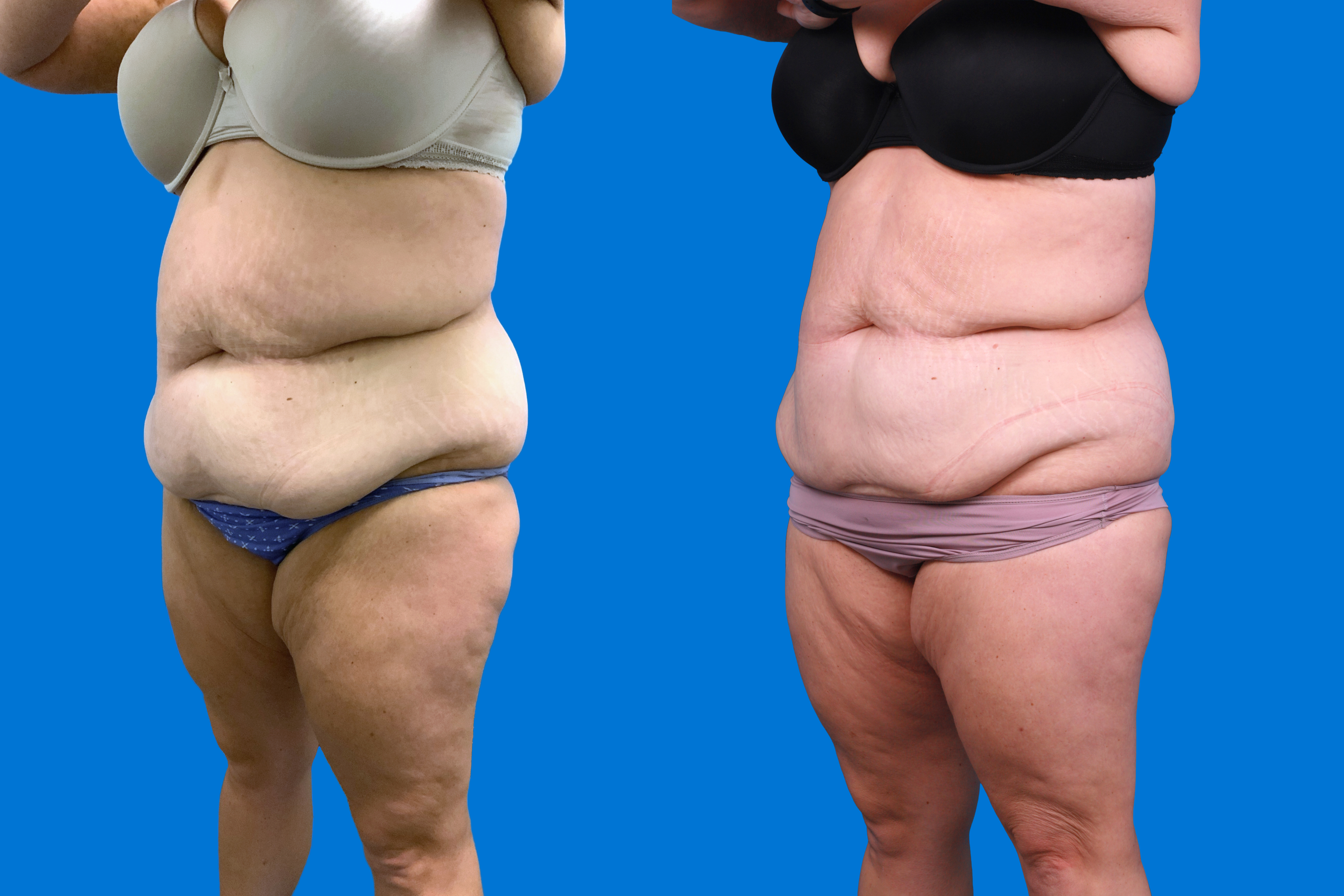 CoolSculpting Before & After Gallery - Patient 428361 - Image 4
