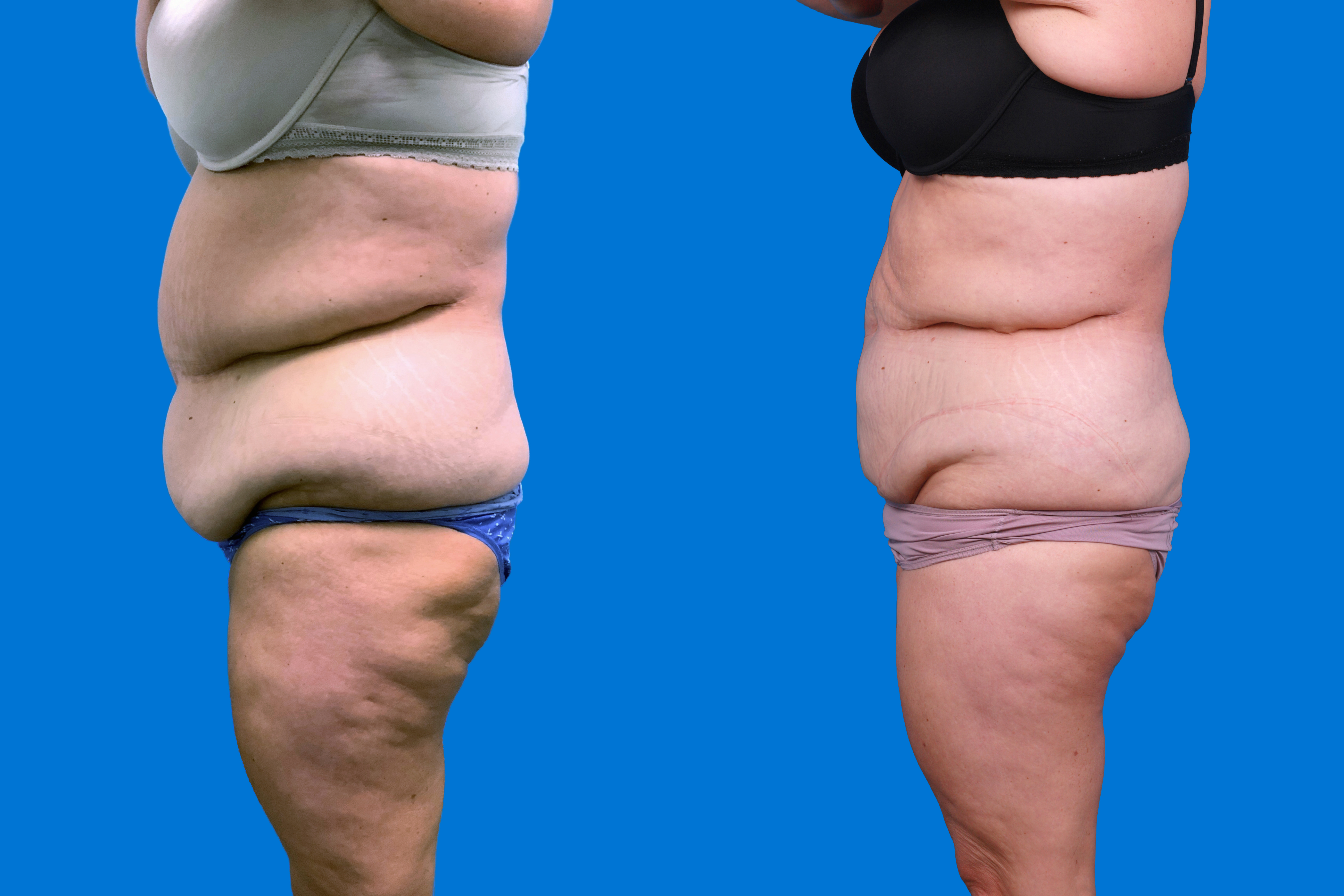 CoolSculpting Before & After Gallery - Patient 428361 - Image 5