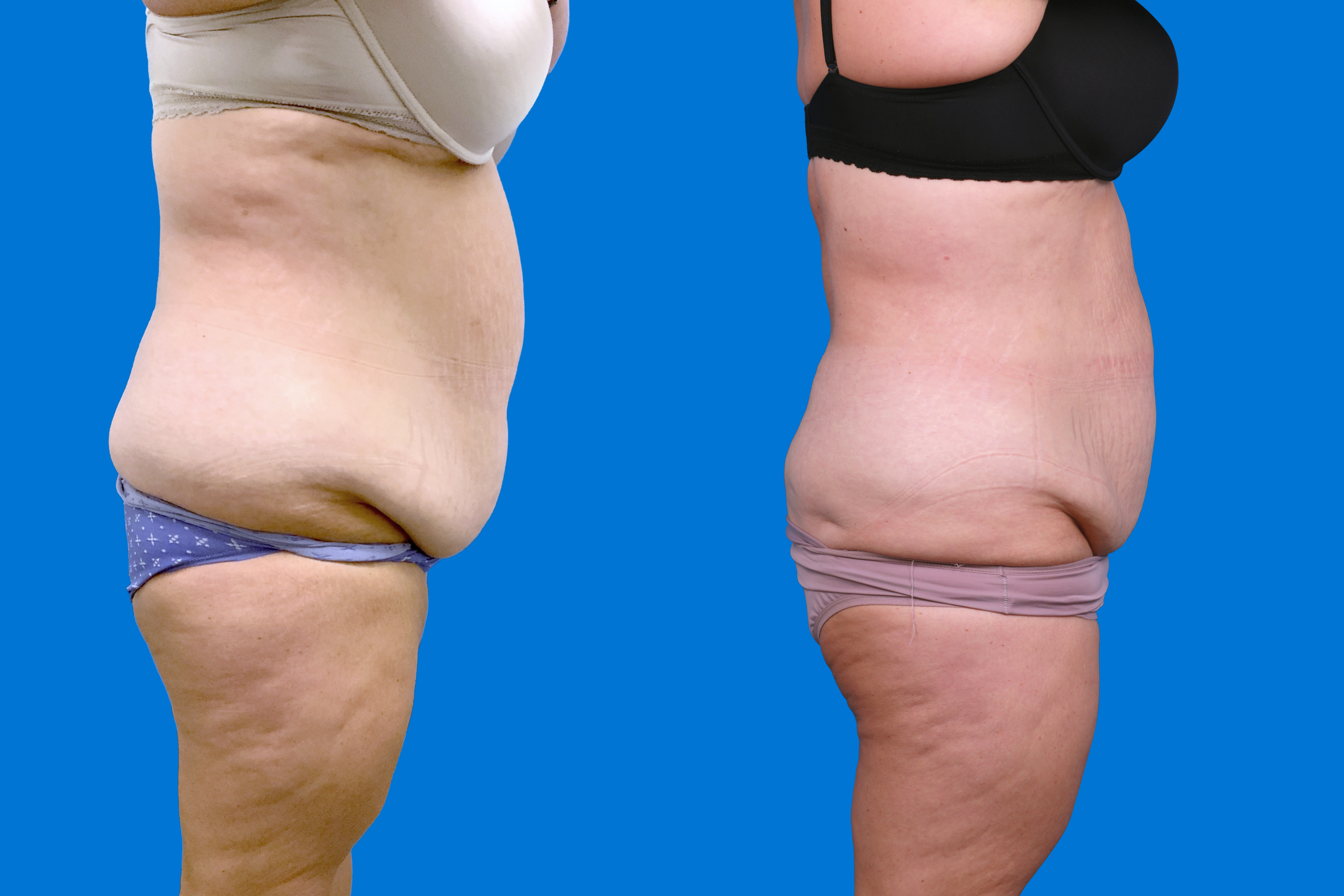 CoolSculpting Before & After Gallery - Patient 428361 - Image 3