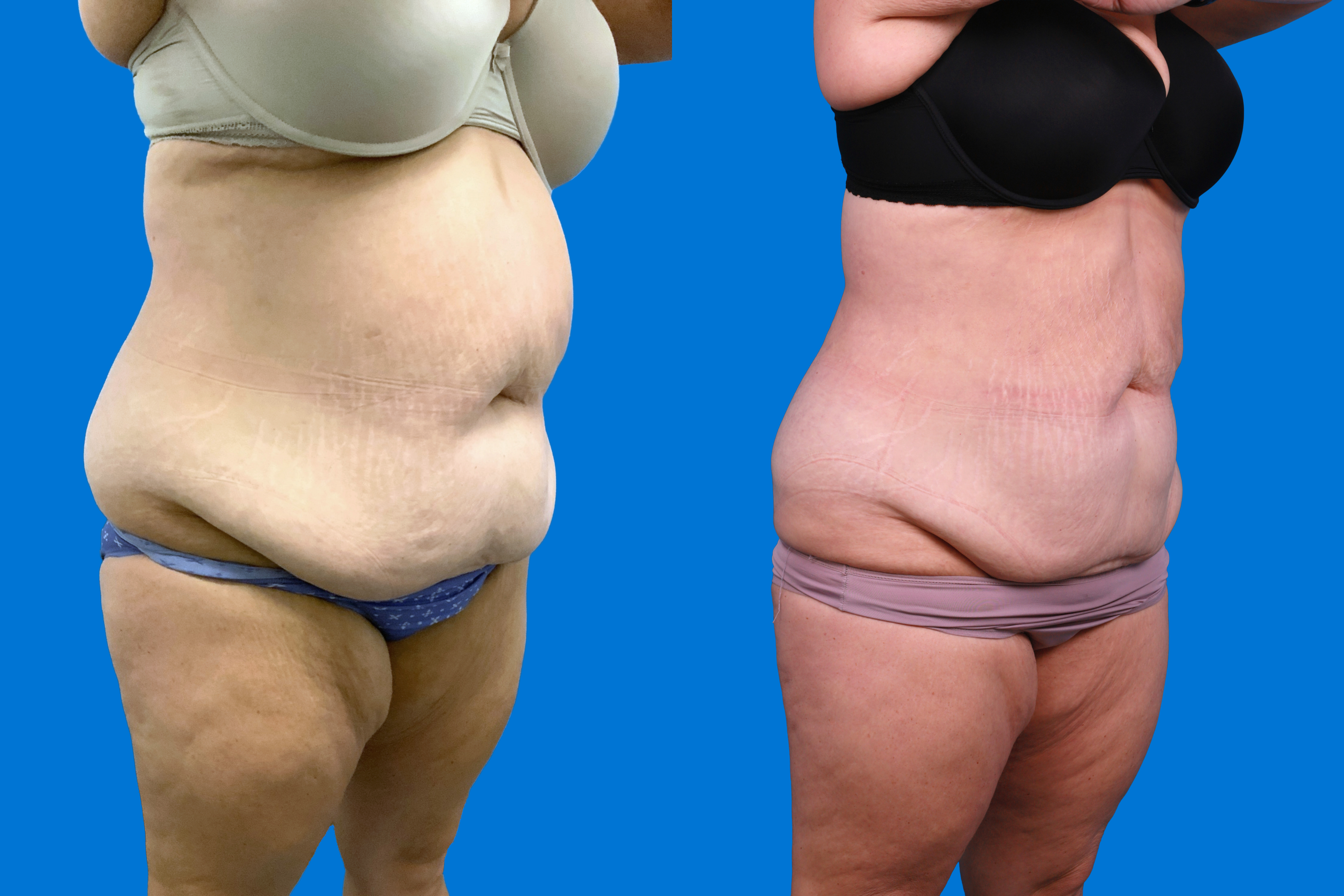 CoolSculpting Before & After Gallery - Patient 428361 - Image 2