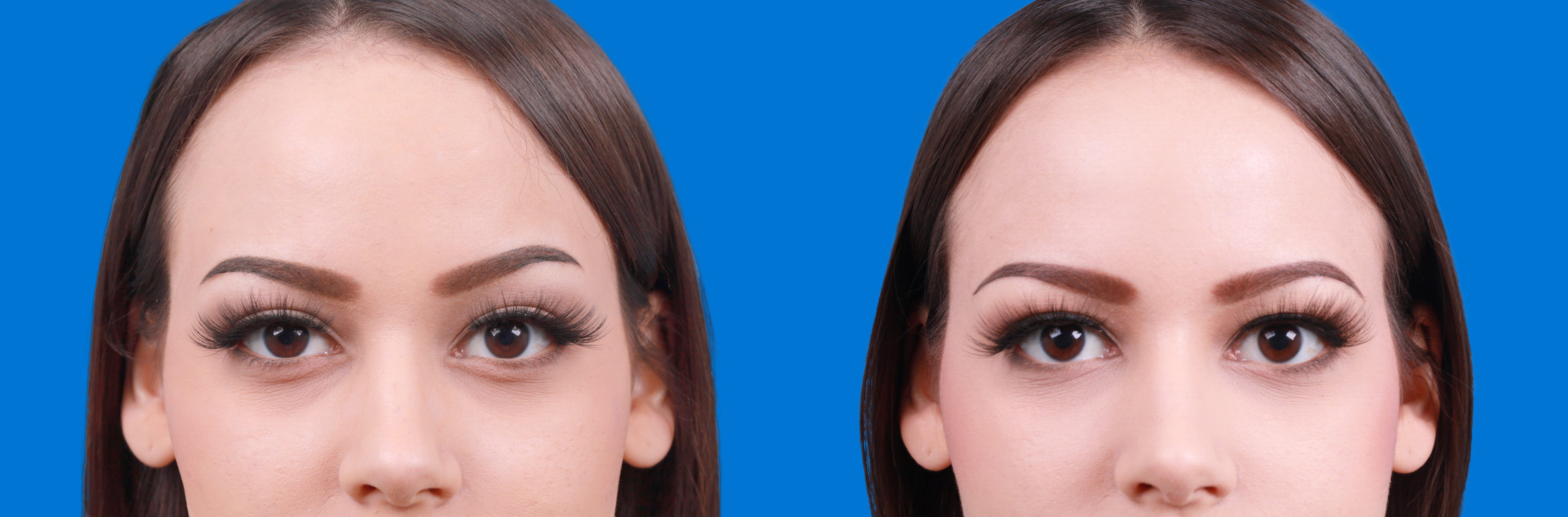 Dermal Fillers Before & After Gallery - Patient 122610219 - Image 1